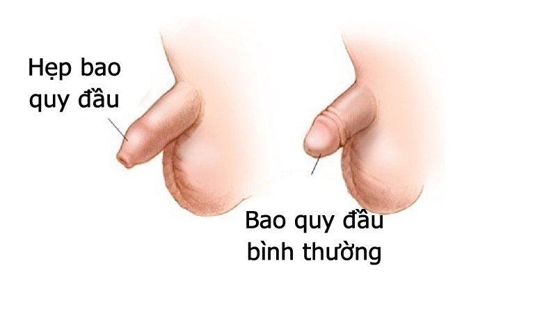 Hẹp bao quy đầu