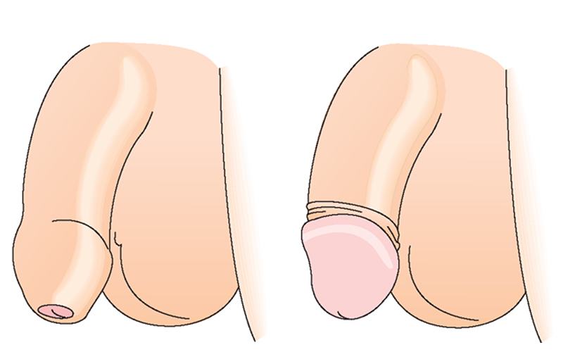 Bao quy đầu có lợi ích gì cho dương vật?