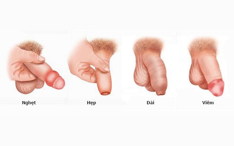 các trường hợp cần cắt bao quy đầu