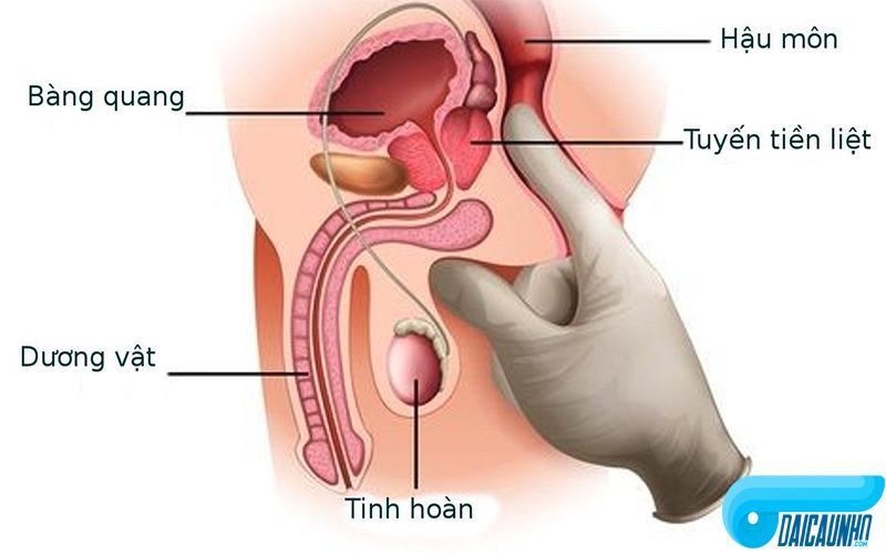 giảm nguy cơ ung thư tuyến tiền liệt