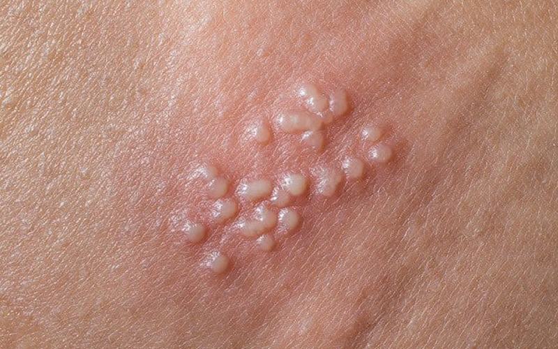 bệnh xã hội là gì