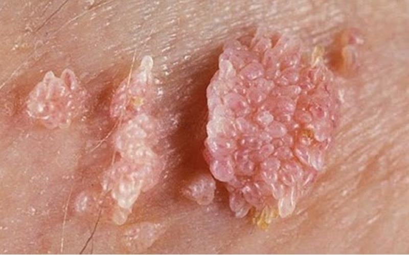 Bệnh sùi mào gà