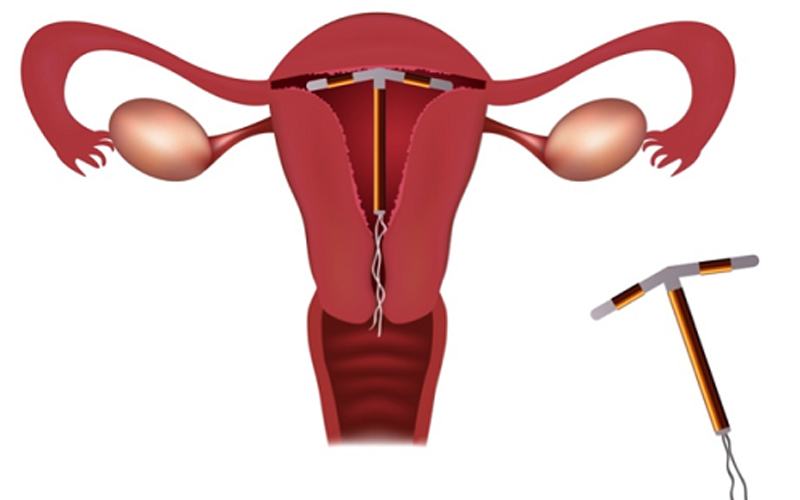 Đặt vòng tránh thai