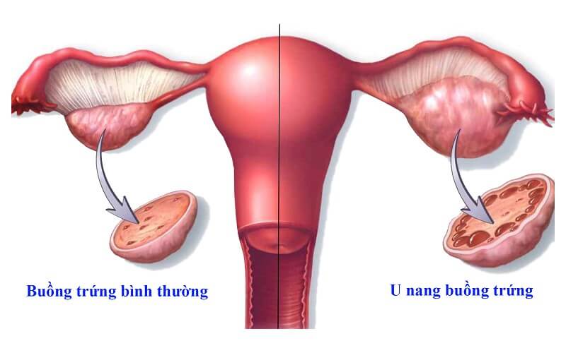 U nang buồng trứng là tình trạng buồng trứng xuất hiện một túi chứa rất nhiều chất lỏng