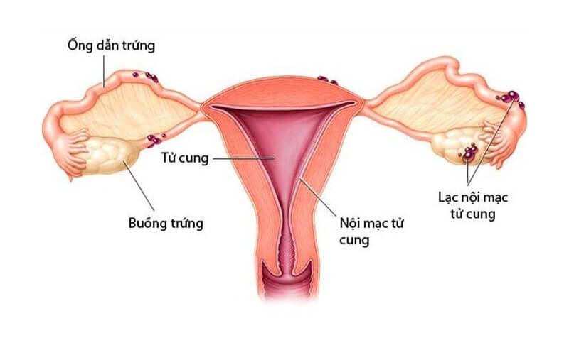 Lạc nội mạc tử cung là khi các tế bào nội mạc tử cung phát triển bên ngoài tử cung
