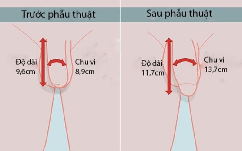 Phẫu thuật nâng cấp cậu nhỏ