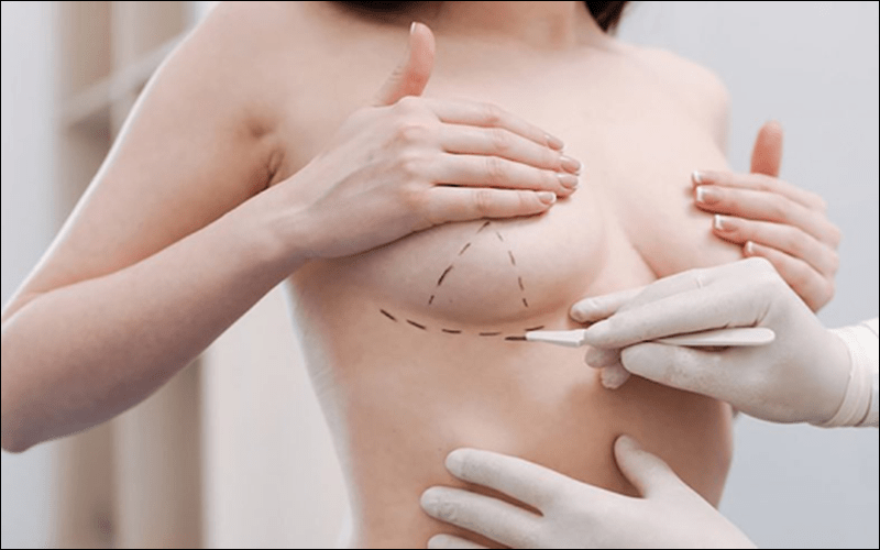 Phẫu thuật này giúp cải thiện kích thước bầu ngực nhanh chóng và duy trì kết quả lâu dài