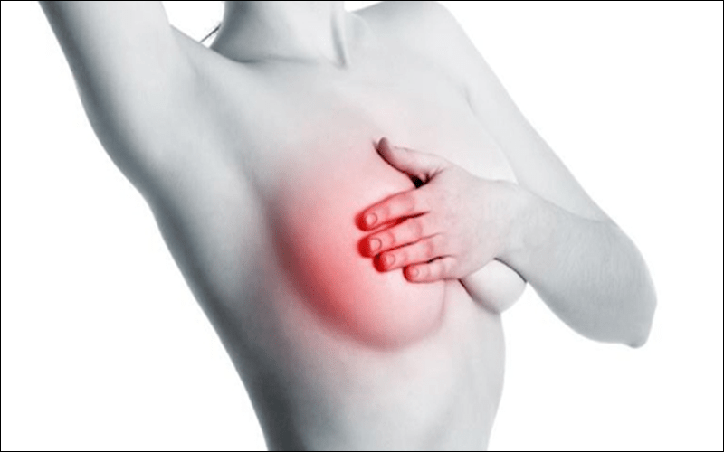 Ung thư vú là một khối u ác tính của vú.