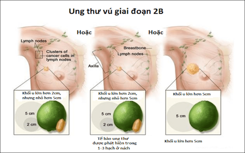Khối u có kích thước 2-4 cm, trong các hạch bạch huyết xuất hiện các cụm tế bào ung thư, có 1-3 hạch bạch huyết gần nách hoặc xương ức