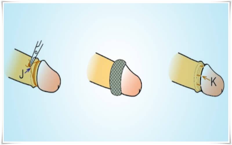 Lưu ý sau khi cắt bao quy đầu