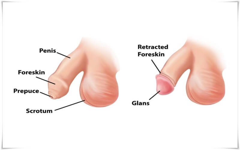 cắt bao quy đầu là gì