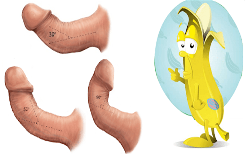 Dương vật bị cong là bệnh gì?
