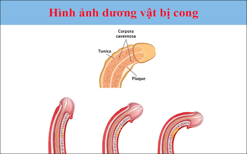 Dương vật cong bẩm sinh: là do sự phát triển không đối xứng của các túi trắng ở một hoặc hai thể hang