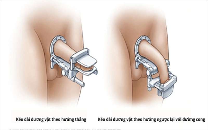 Đối với điều trị ngoại khoa, bệnh nhân sẽ được bác sĩ theo dõi ít ​​nhất 12 tháng